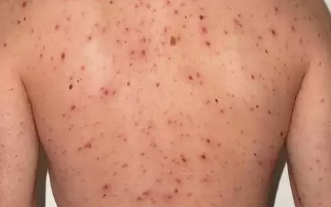 Todo lo que hay que saber del sarampi�n, la enfermedad m�s contagiosa que resurge por la falta de vacunaci�n
