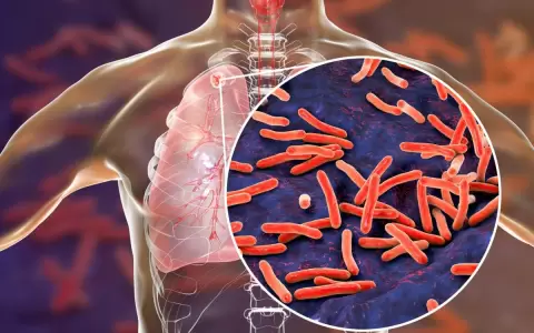 Hoy se recuerda el D�a Mundial de la Tuberculosis