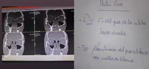 El diagn�stico fue de fractura de la �rbita ocular.