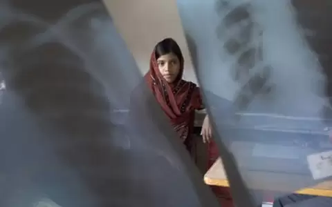 La tuberculosis ataca principalmente a los pulmones.