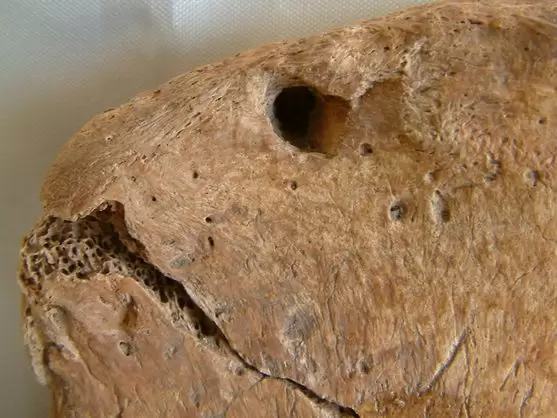 La marca que revela la mordedura del le�n en la cadera del gladiador romano.