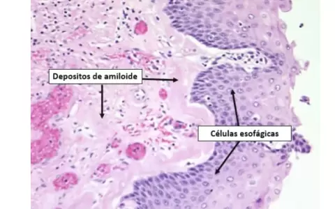 Amiloidosis.