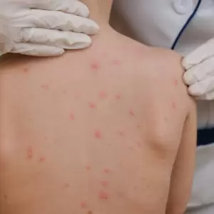 Paraguay activa alerta por sarampi�n ante confirmaci�n de m�s casos