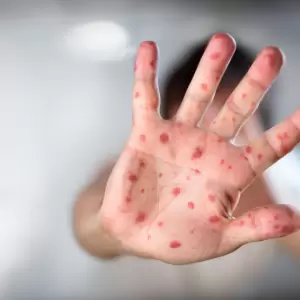 Confirman siete casos positivos de sarampión en los últimos días