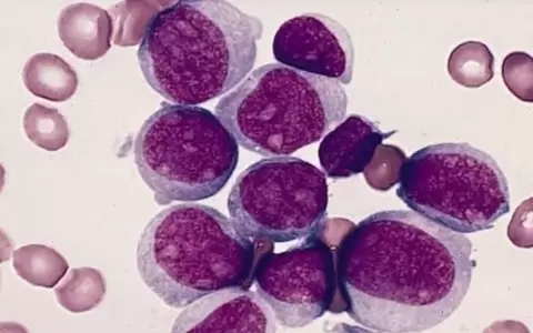 La leucemia mieloide aguda es el tipo m�s com�n de leucemia aguda en adultos.