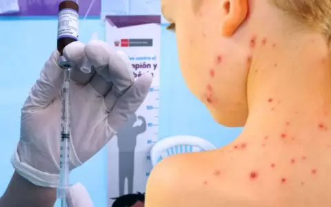 Detectan un caso de sarampi�n en Central.