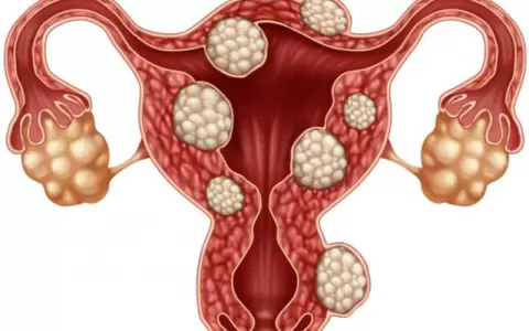 Mioma en el cuello uterino.