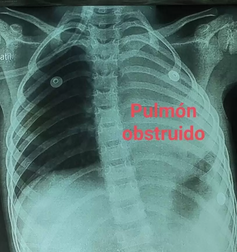 Maíz incrustado en el pulmón izquierdo. Foto: X