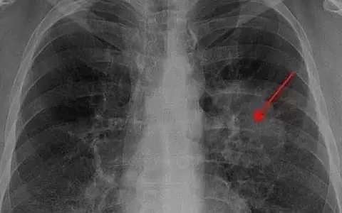Pulm�n visiblemente da�ado por el c�ncer.