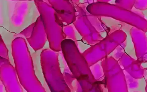 Raro s�ndrome que podr�a ser provocado por las bacterias intestinales Escherichia coli.