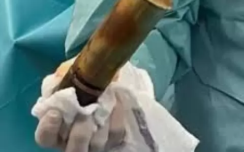 Esta granada fue extra�da del recto de un paciente en el Hospital Rangueil de Toulouse, en Francia.