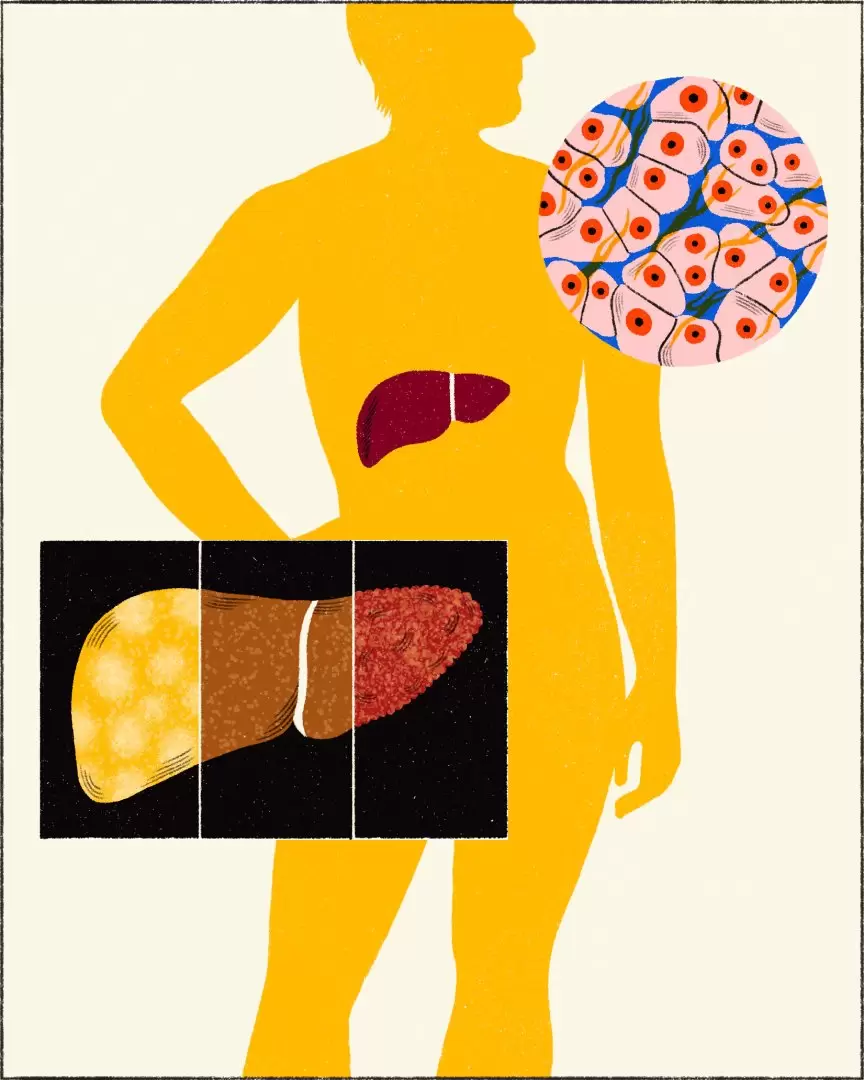 Efectos del alcohol en el cuerpo. Foto: Montse Galbany / The New York Times.