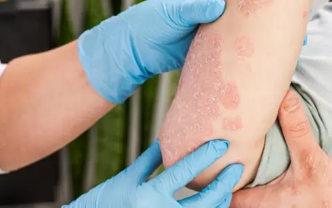 Psoriasis.