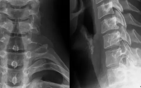 Radiograf�a aut�ntica de la zona cervical.