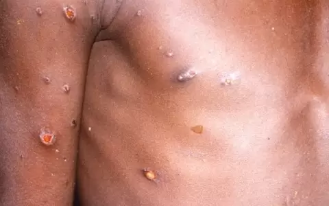 La viruela del mono produce lesiones cut�neas, fiebre y dolor corporal en las personas afectadas por el virus.