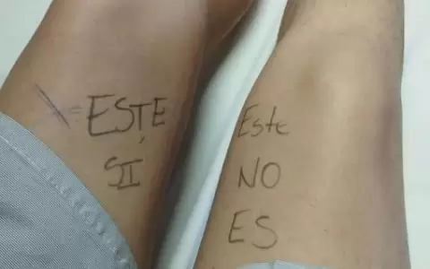 Joven se marca la pierna antes de cirug�a para evitar error m�dico en Pedro Juan Caballero.