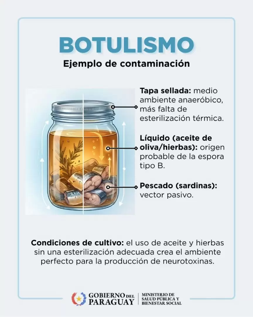 Botulismo por intoxicación alimentaria.