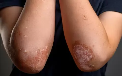 Psoriasis.
