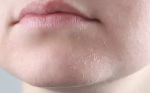 Cuidados de la piel en invierno.