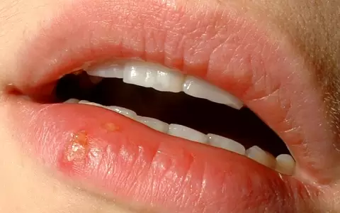 Herpe labial.